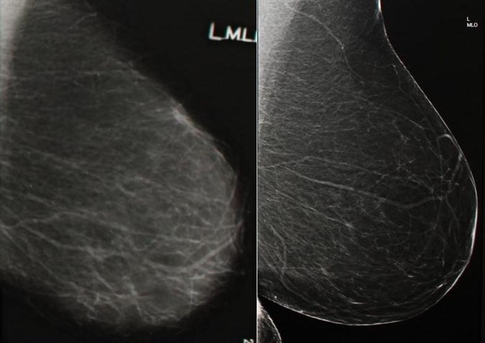 The new digital mammography machine greatly improves image quality. Here, you can see results from the old machine (left) and the new one (right). 