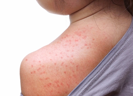 More measles cases confirmed in Interior Health region