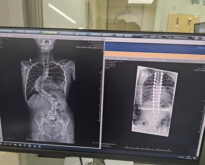 This X-ray shows the spinal curve from scoliosis in Kamloops resident Aubrey Spahmann