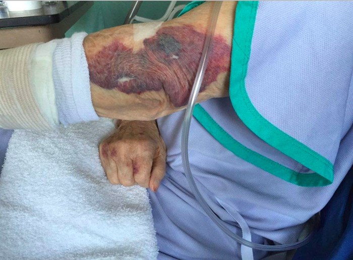 The bruises Houston sustained after she was assaulted by a fellow resident June 2015. 