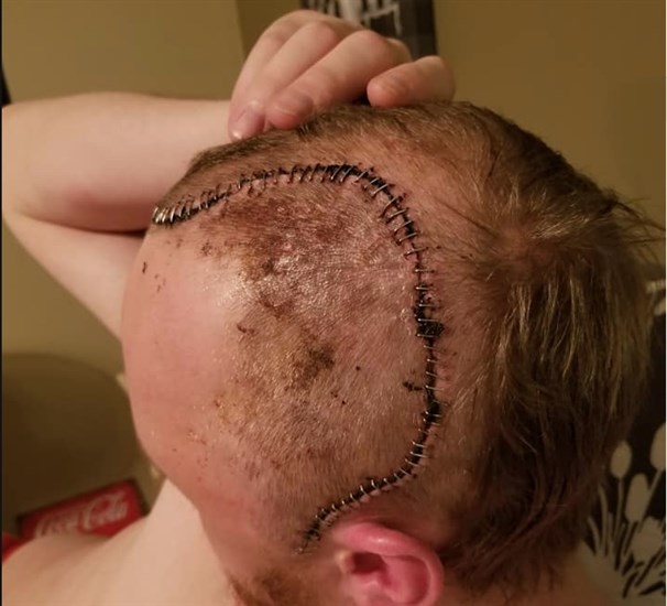 Bradley Eliason shows the extent of his most recent surgery repairing his skull. 