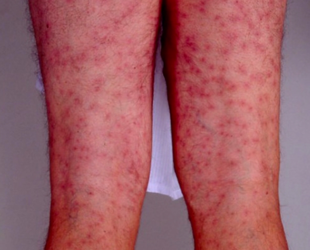 bump pattern swimmers itch