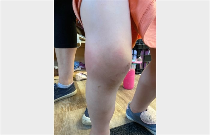 Kamloops resident Heather Asselstine, who lives in Juniper Ridge, says her children have been experiencing bigger reactions to mosquito bites this spring. This photo shows her youngest daughter's knee swollen from a mosquito bite.