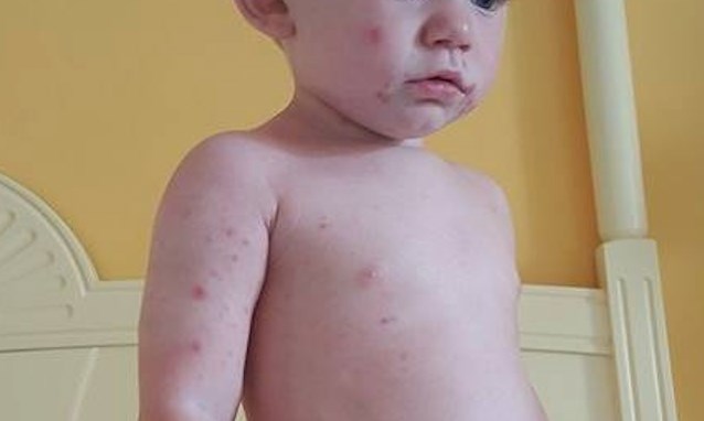Hand, foot and mouth disease is a common virus that typically affects children and can cause painful spots and blisters on the mouth, in the throat and on hands and feet.
