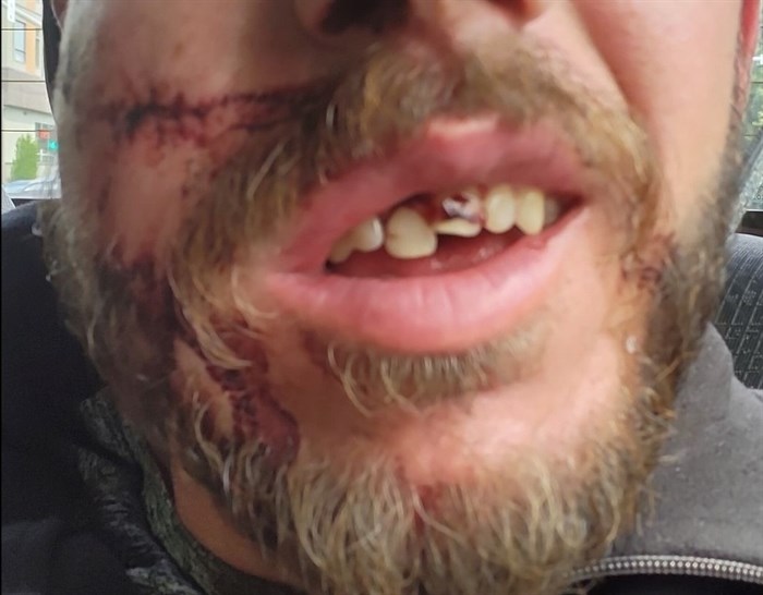 A 29-year-old Vernon man had his jaw broken when he was attacked with a tire iron.